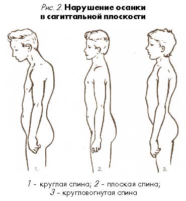 Как называется нарушение осанки изображенное на рисунке 2